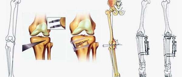 Остеотомия колена